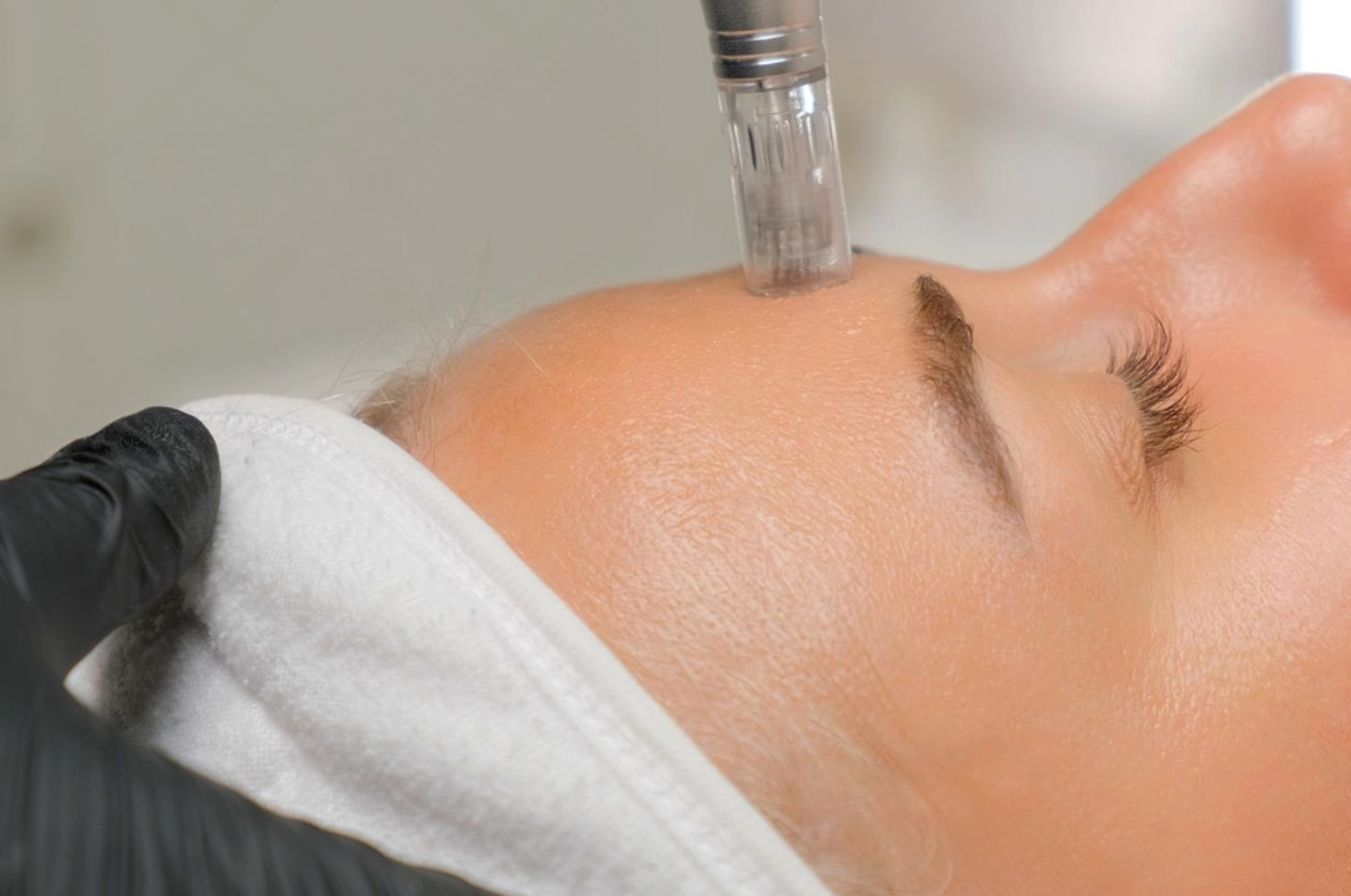 Médecine esthétique Paris 16 — injections microneedling peeling